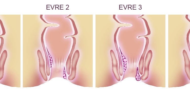 Hemorrhoid,Stages.,Illustration,Of,Unhealthy,Lower,Rectum,With,Inflamed,Vascular